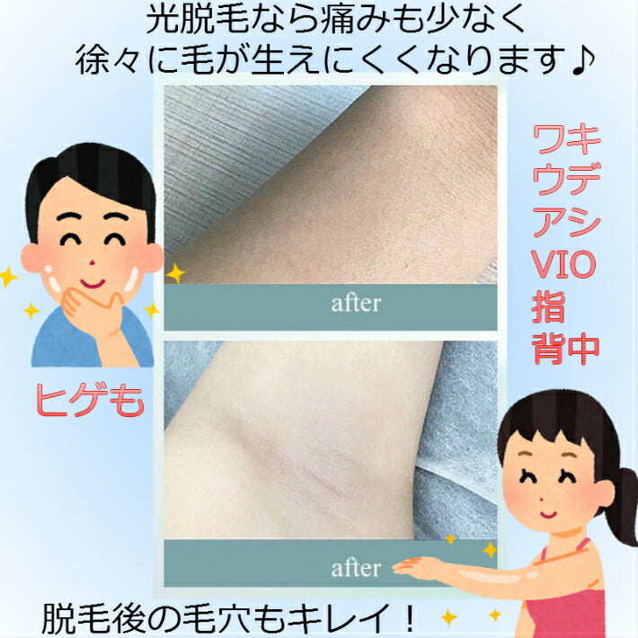 IPL 光 脱毛器 90万回 フラッシュ ライト交換不要 家庭用 脱毛機 美顔器 ヒゲ脱毛 レーザー 全身 脱毛 メンズ レディース ムダ毛 処理 デリケートゾーン アンダーヘア vioライン 顔 背中 ボディ フェイス ヒゲ ひげ 髭 脇 腕 指 ワキ ウデ 顔 自動照射 人気